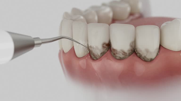 Trusted Dental Crowns And Bridges service in Lexington, WA - Dentist Open Now